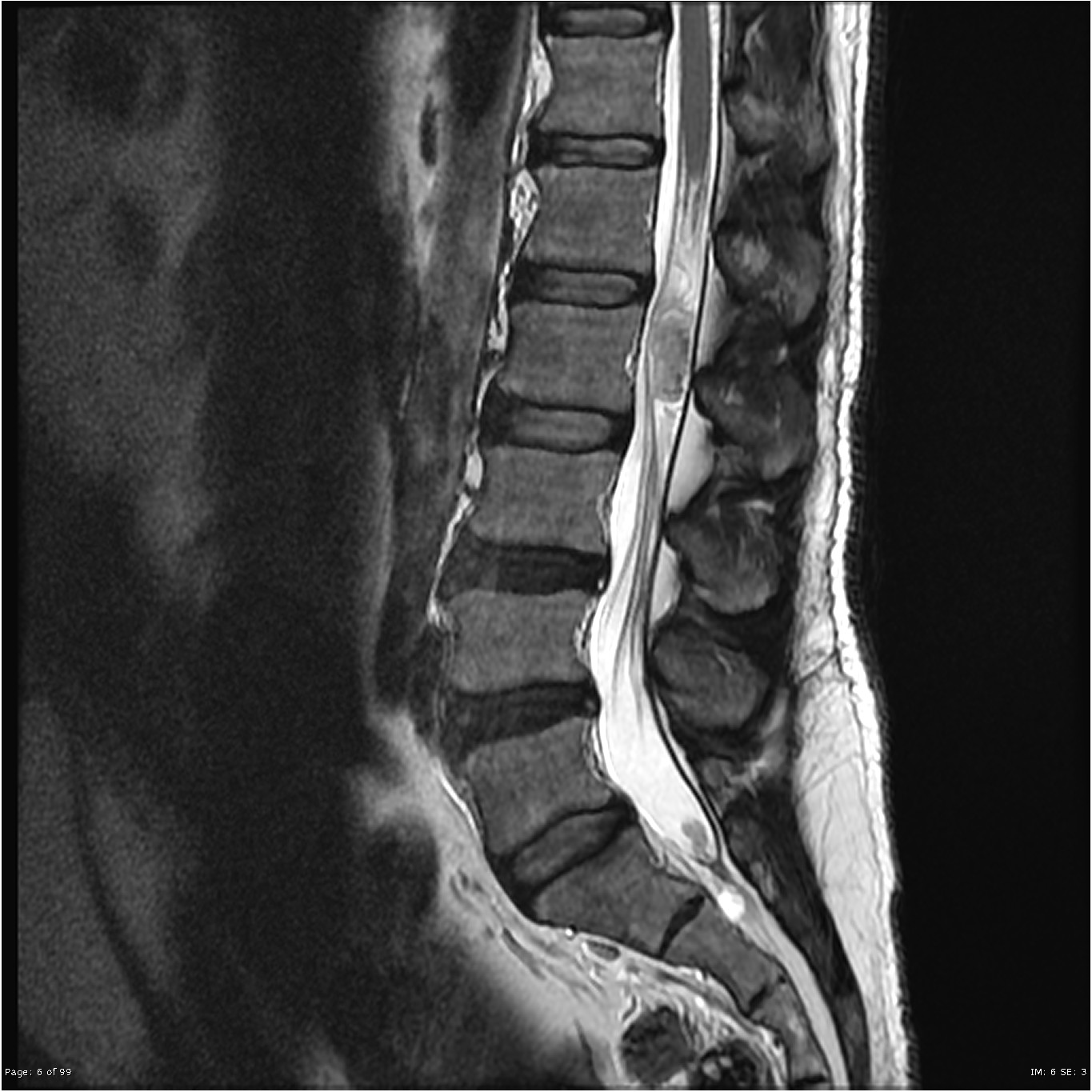 Myxopapillary ependymoma | Image | Radiopaedia.org