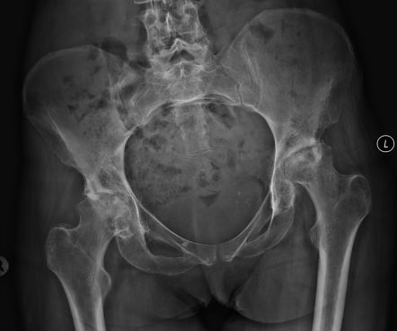 Avascular Necrosis Of Femoral Head Radiology Case Radiopaedia Org