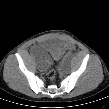 Pelvic haemolymphocele | Radiology Case | Radiopaedia.org