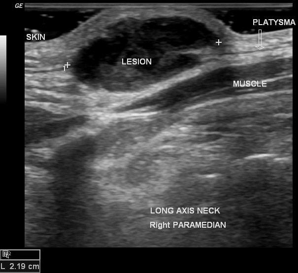 Thyroglossal Duct Cyst Image