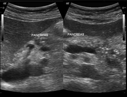 Pancreatic calcification | Radiology Case | Radiopaedia.org