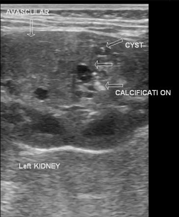 Wilms tumor | Radiology Reference Article | Radiopaedia.org