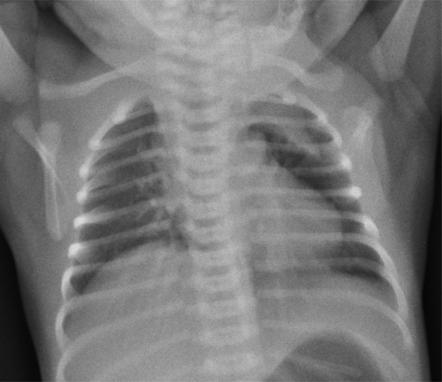 Thymus | Radiology Reference Article | Radiopaedia.org