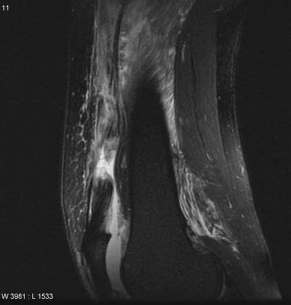 Quadriceps tendon rupture | Radiology Reference Article | Radiopaedia.org