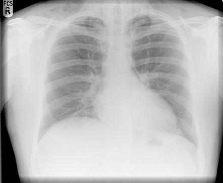 Pneumomediastinum | Radiology Case | Radiopaedia.org