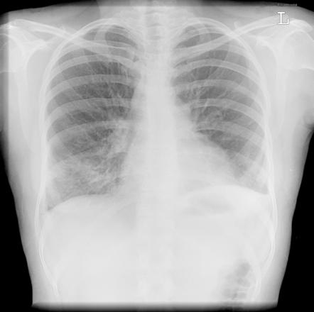 Middle lobe bronchiectasis | Radiology Case | Radiopaedia.org