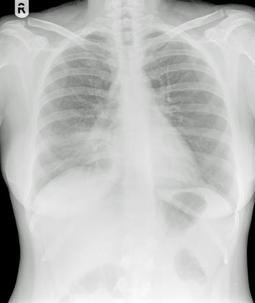 Middle lobe consolidation | Radiology Case | Radiopaedia.org