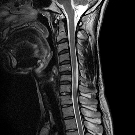 Hirayama disease | Radiology Case | Radiopaedia.org