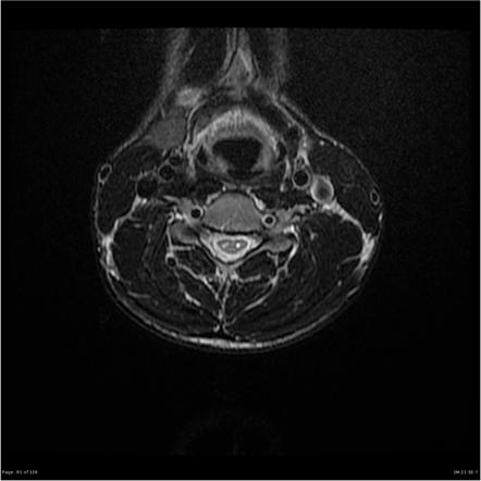 Hirayama disease | Image | Radiopaedia.org