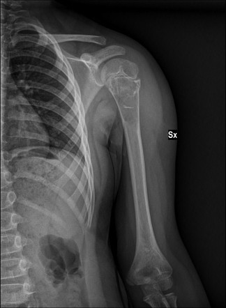 Unicameral bone cyst: fallen fragment sign | Image | Radiopaedia.org