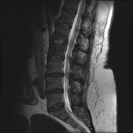 Spondylodiscitis | Image | Radiopaedia.org