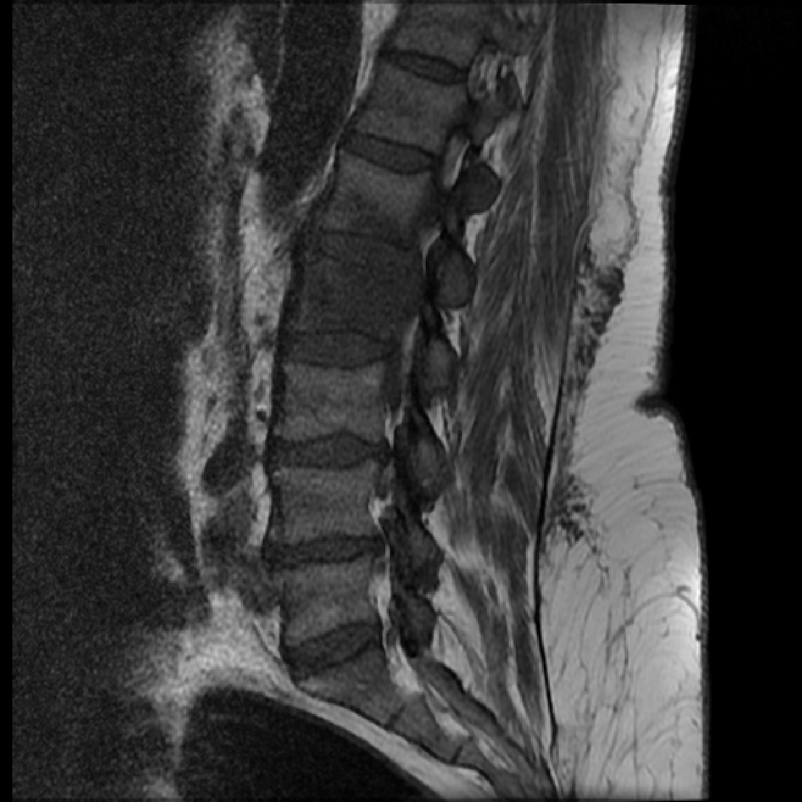 Spondylodiscitis | Image | Radiopaedia.org