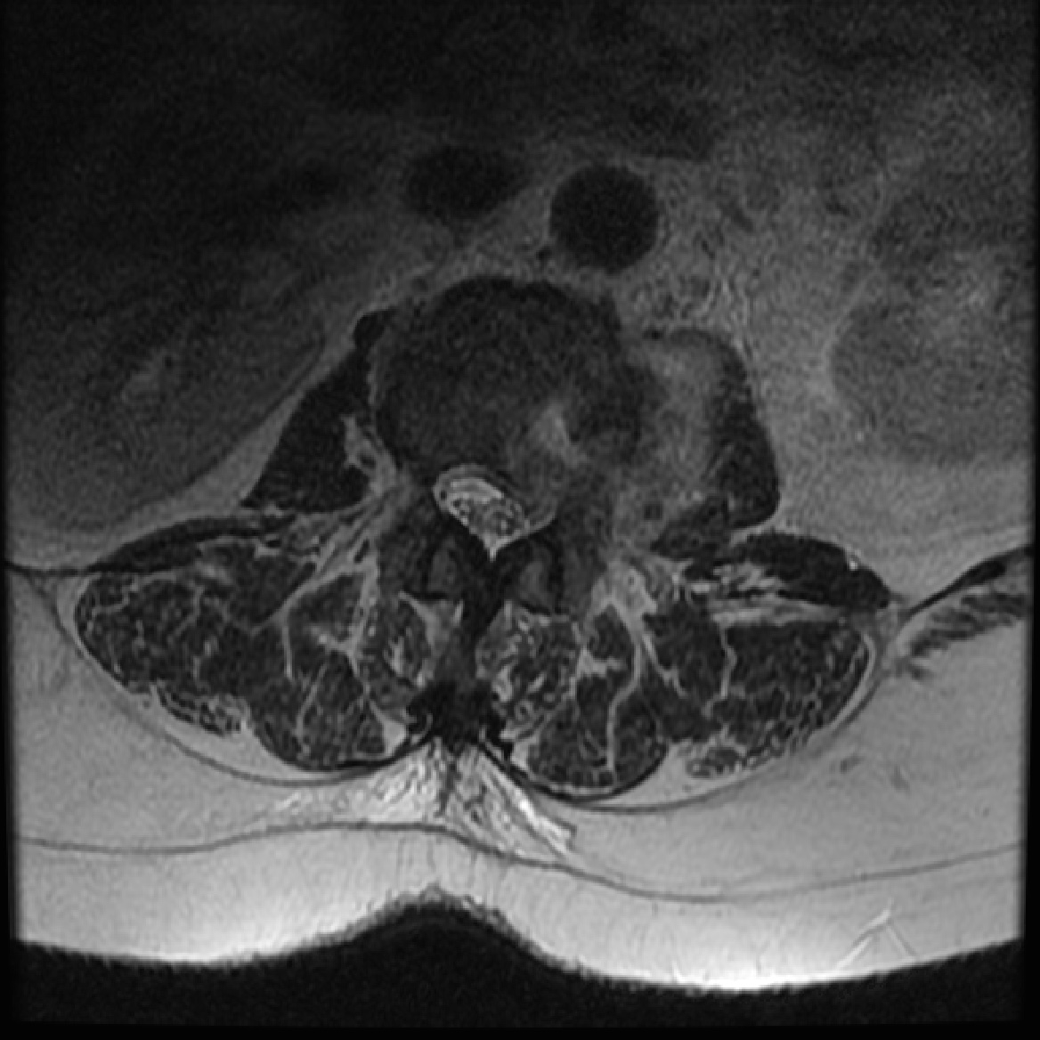 Spondylodiscitis | Image | Radiopaedia.org