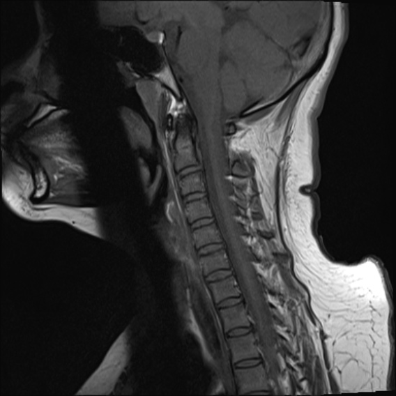 Hangman's fracture | Image | Radiopaedia.org