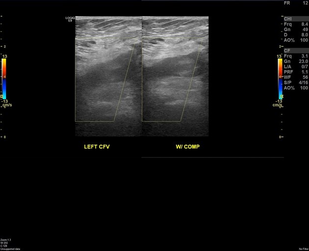 Trousseau Syndrome Gallbladder Carcinoma Presenting With Bilteral