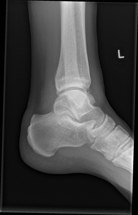 Posteromedial tubercle fracture of the talus | Image | Radiopaedia.org