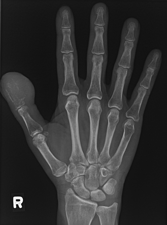 Bone and lung metastases | Radiology Case | Radiopaedia.org