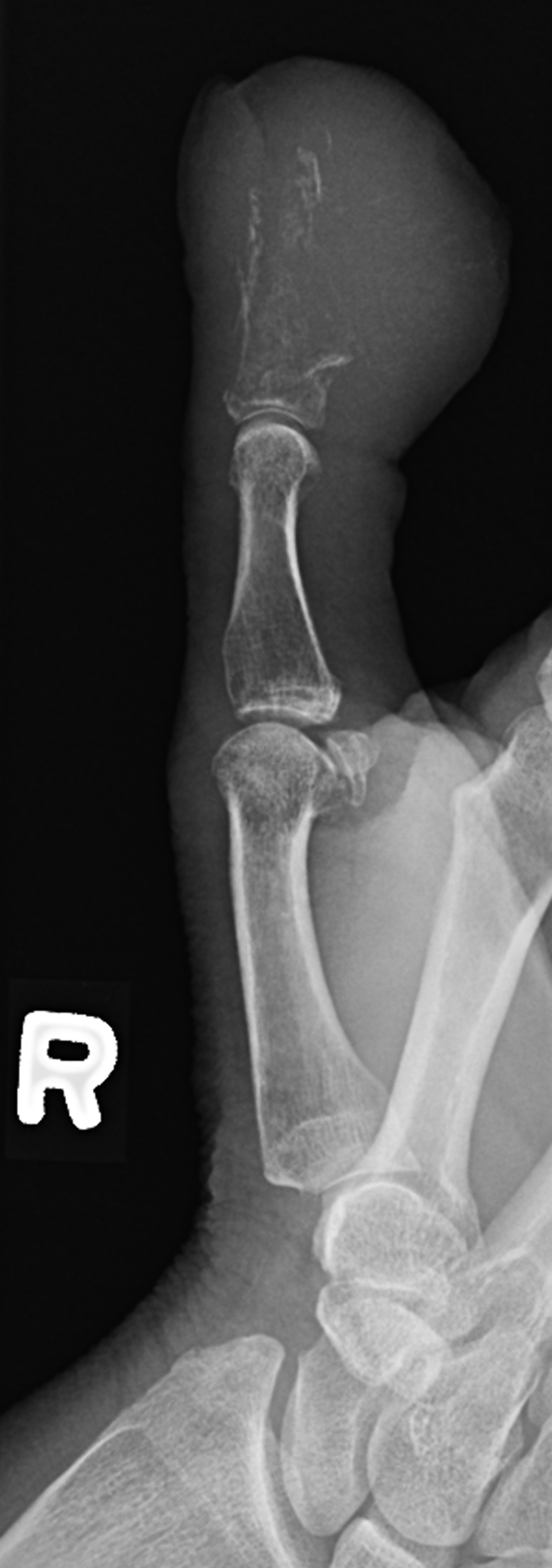 Sarcoma metastasis | Image | Radiopaedia.org