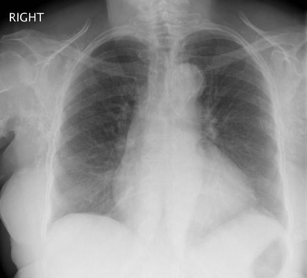 Dermatomyositis | Radiology Case | Radiopaedia.org