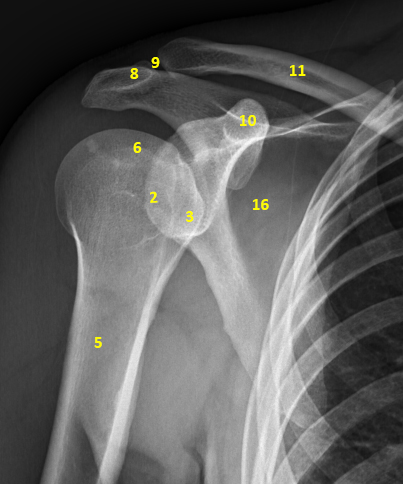 Бугорок плечевой кости фото. Бугристость плечевой кости рентген. Перелом большого бугорка плечевой кости рентген. Перелом бугорка плечевой кости рентген. Остеосинтез большого бугорка плечевой кости.