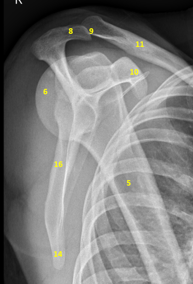 File:Shoulder - annotated x-rays (Radiopaedia 45952-50274 Lateral ...