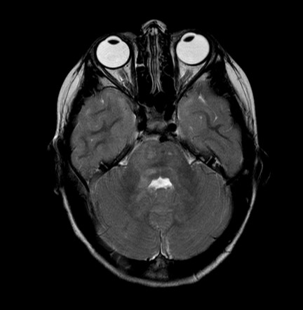 Focal areas of signal intensity (FASI) - neurofibromatosis type 1 ...