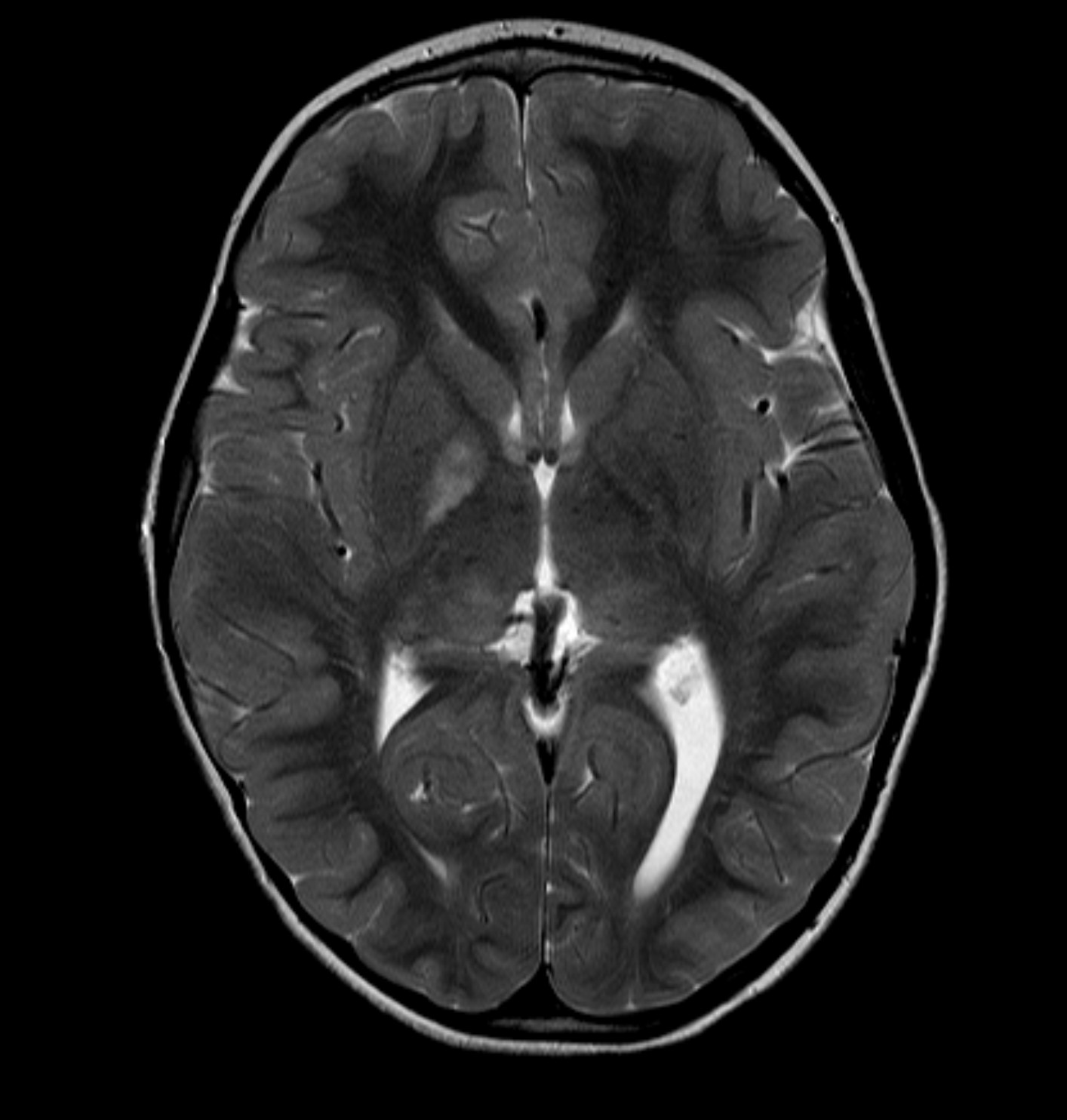 Focal areas of signal intensity (FASI) - neurofibromatosis type 1 ...