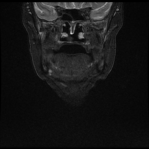 Exophytic papilloma - squamous subtype | Image | Radiopaedia.org