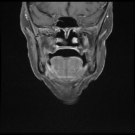 Exophytic papilloma - squamous subtype | Image | Radiopaedia.org