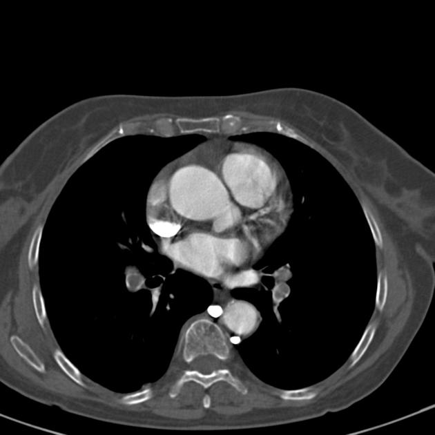 Egg and banana sign (pulmonary hypertension)