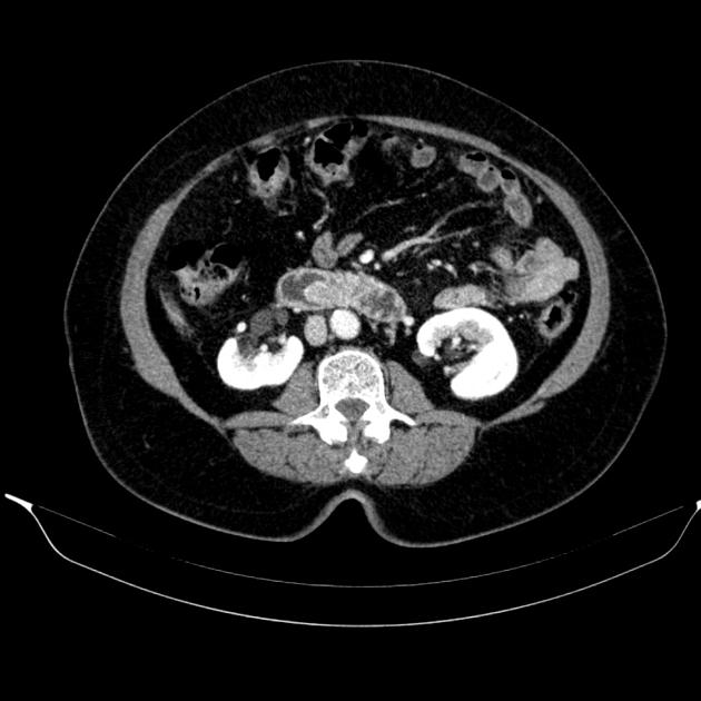 Ampulla Of Vater Cancer