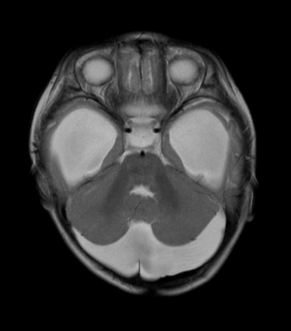 Arachnoid Cyst Of The Posterior Fossa With Hydrocephalus Image 3874