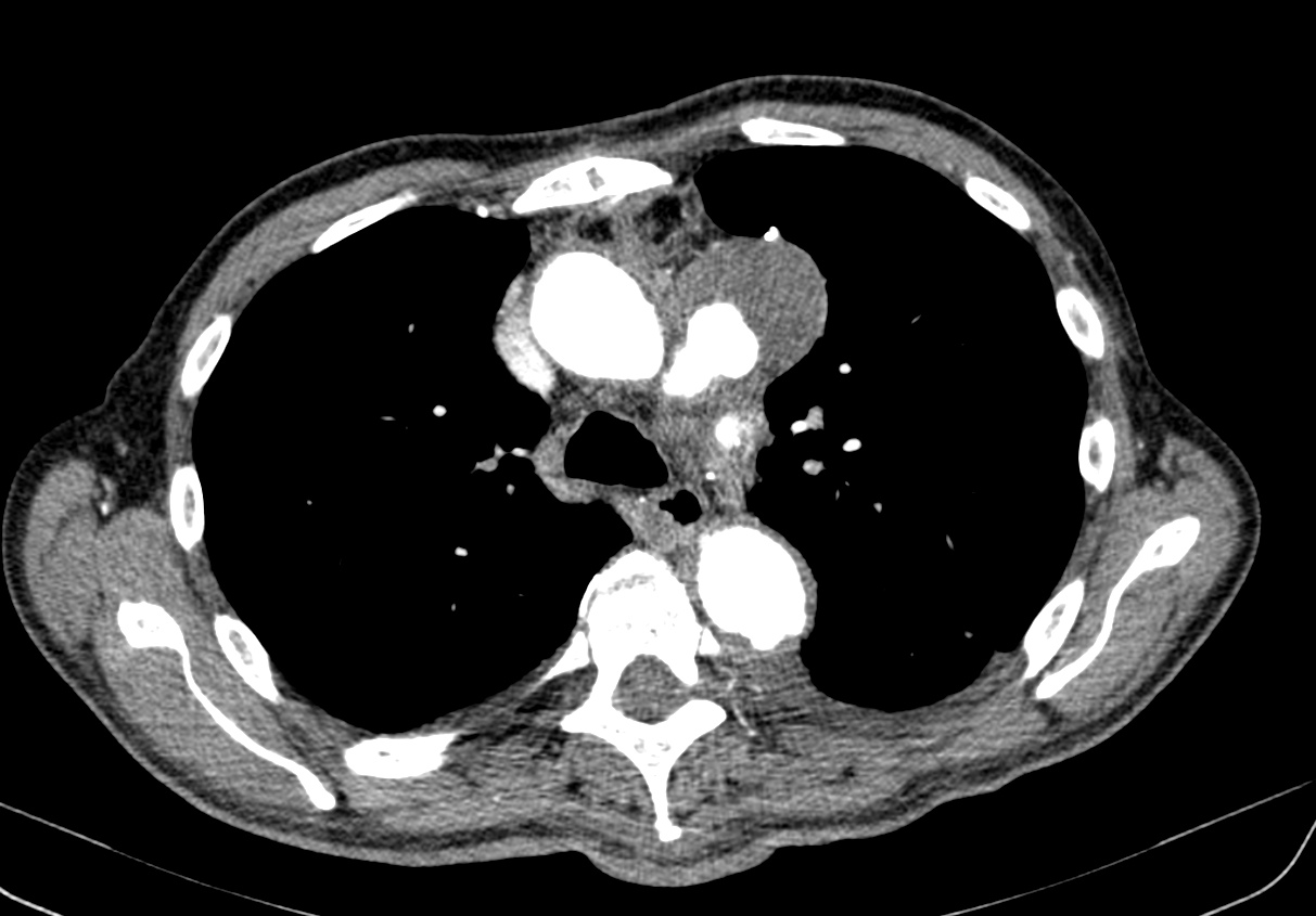 Aortic Arch Saccular Aneurysm Image Radiopaedia Org