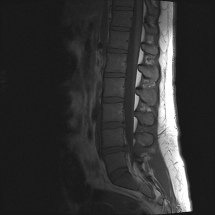 Left subarticular zone disc extrusion with nerve root impingement ...