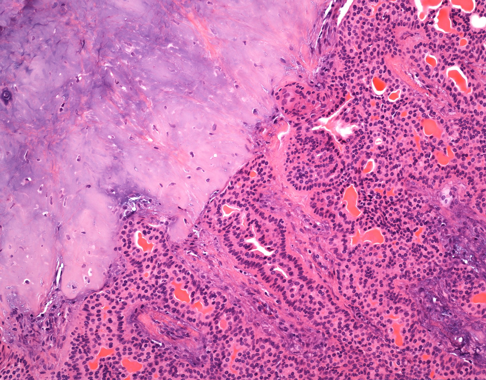 Pleomorphic Adenoma Parotid Gland Image