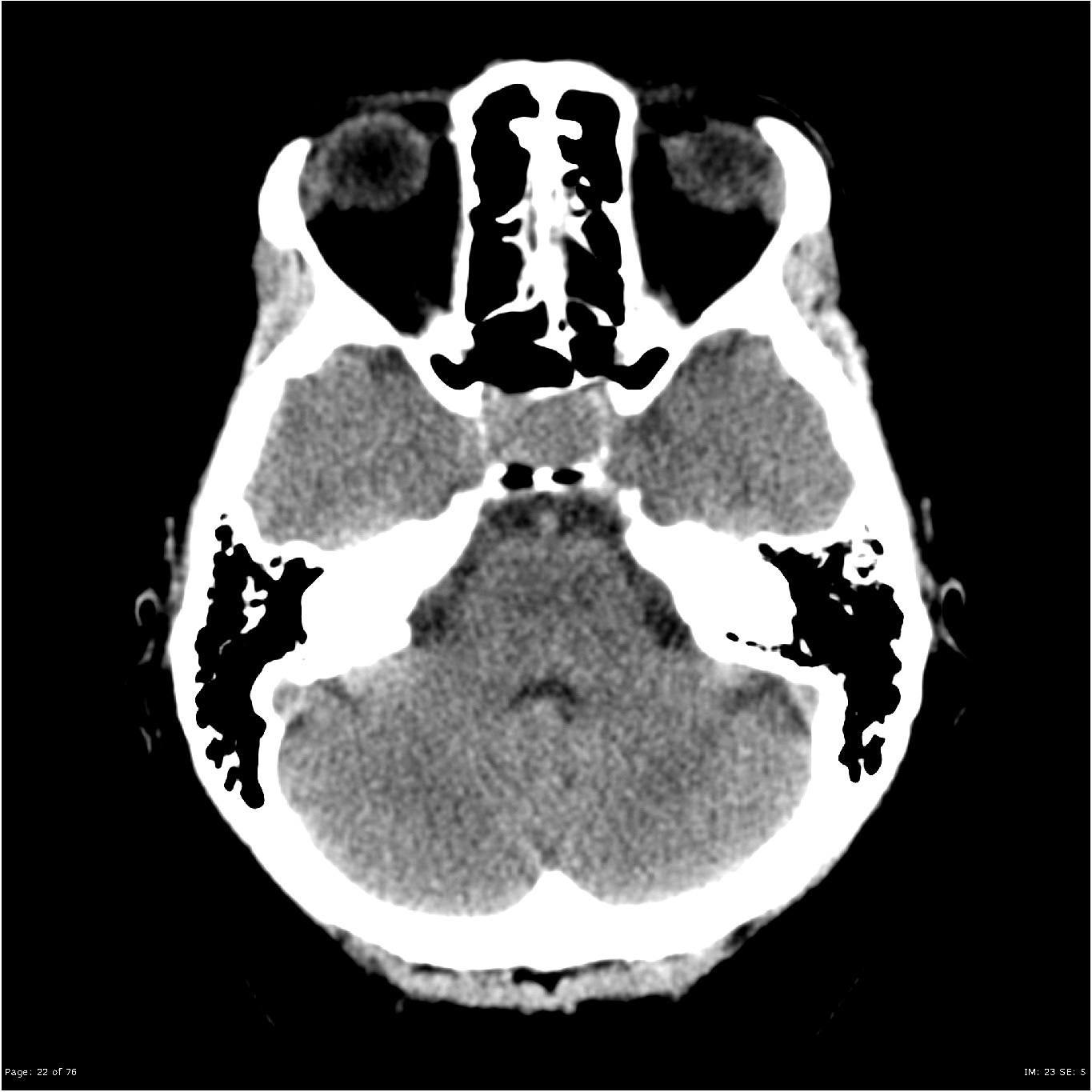 Rubinstein-Taybi syndrome - wikidoc