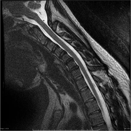 Hirayama Disease 