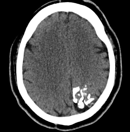 Sturge-Weber syndrome | Radiology Case | Radiopaedia.org