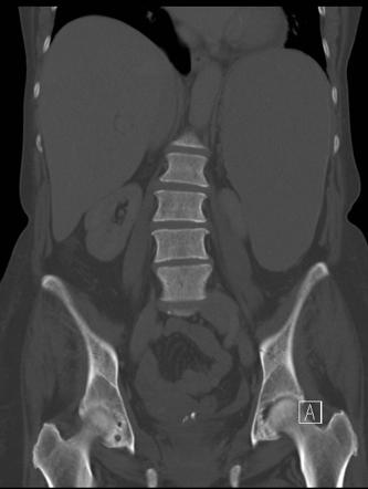 Myelofibrosis | Radiology Case | Radiopaedia.org