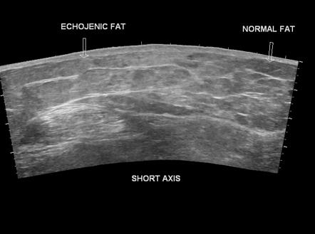 Subcutaneous fat contusion of thigh - ultrasound | Image | Radiopaedia.org