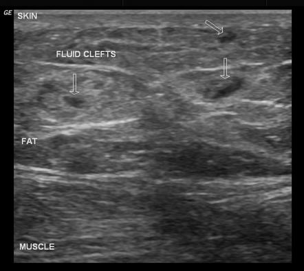 Ultrasonography Images Of The Thigh From Lipedema Left