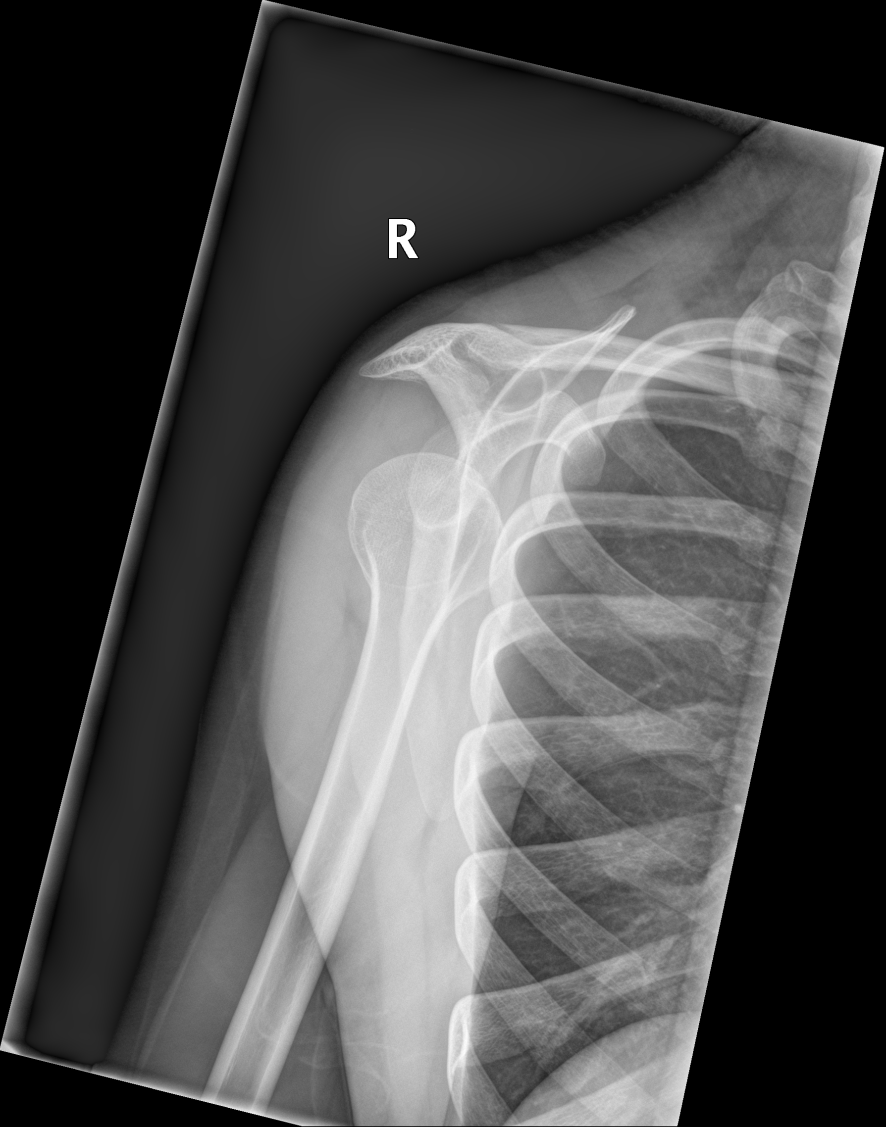 Inferior shoulder dislocation | Image | Radiopaedia.org