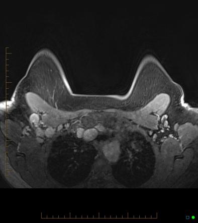 Vaccine induced axillary lymphadenopathy breast MRI Radiology