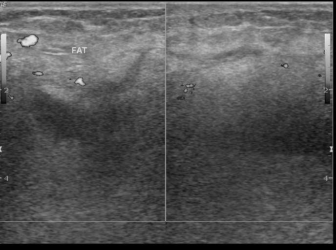 Inguinal hematoma | Image | Radiopaedia.org