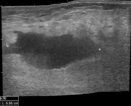 Inguinal hematoma | Image | Radiopaedia.org