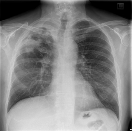 Cavitating pneumonia | Image | Radiopaedia.org