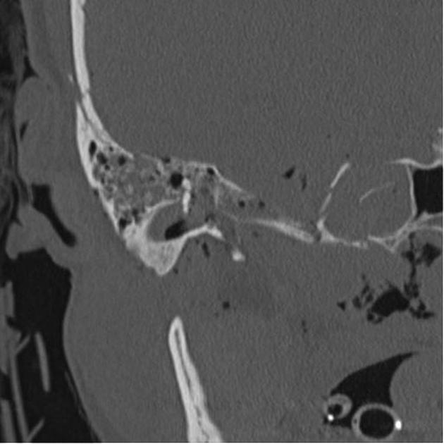 Temporal bone fracture Radiology Reference Article Radiopaedia