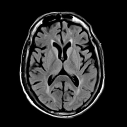 Hepatic encephalopathy | Radiology Reference Article | Radiopaedia.org