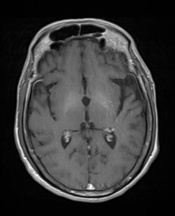 Hepatic encephalopathy | Image | Radiopaedia.org