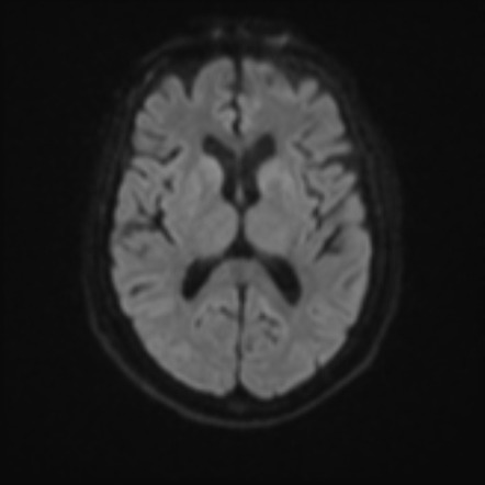 Hepatic encephalopathy | Image | Radiopaedia.org